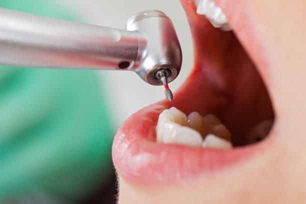 Best Emergency Dentist for Lost Fillings or Crowns in Charlotte, TN